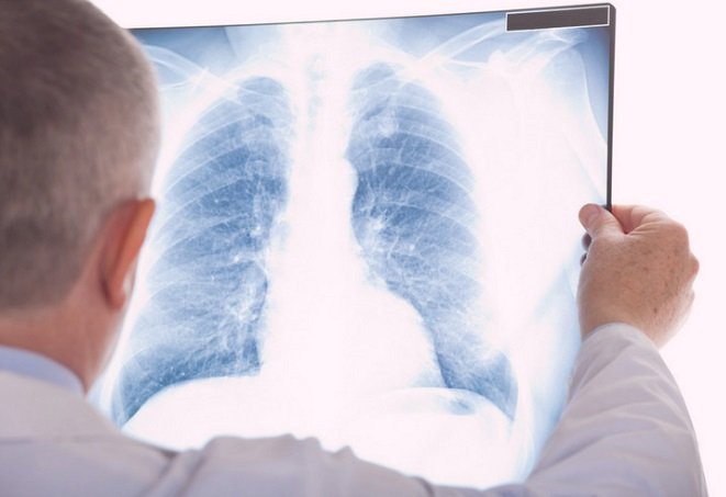 Novo remédio para tumor no pulmão em estágio disseminado ganha aval da agência federal